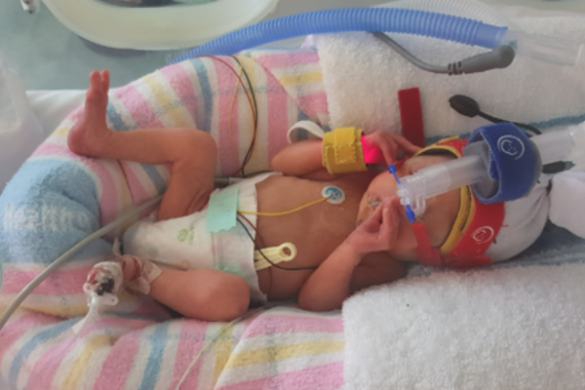 premature baby
